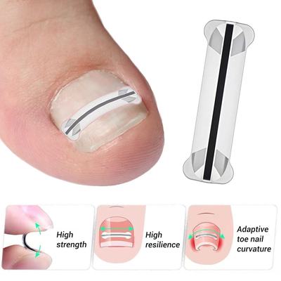 Titanium Alloy Ingrown Toenail Treatment